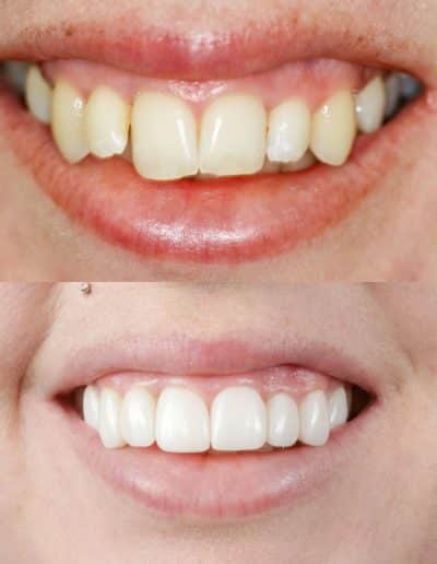 Smile Makeover, porcelain veneers, before and after photo.