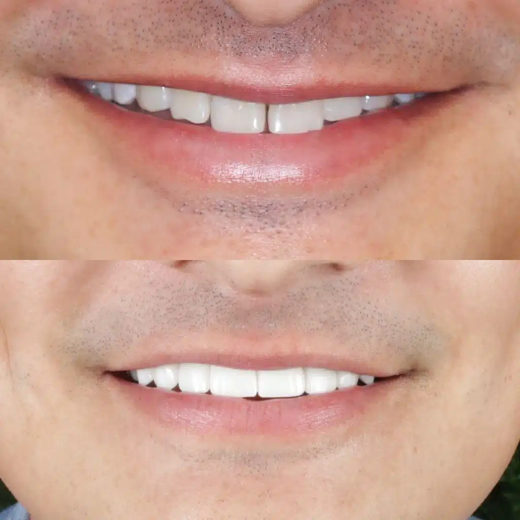 Smile Makeover, porcelain veneers, before and after photo.