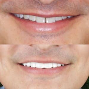 Smile Makeover, porcelain veneers, before and after photo.