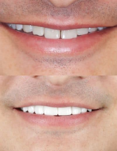 Smile Makeover, porcelain veneers, before and after photo.
