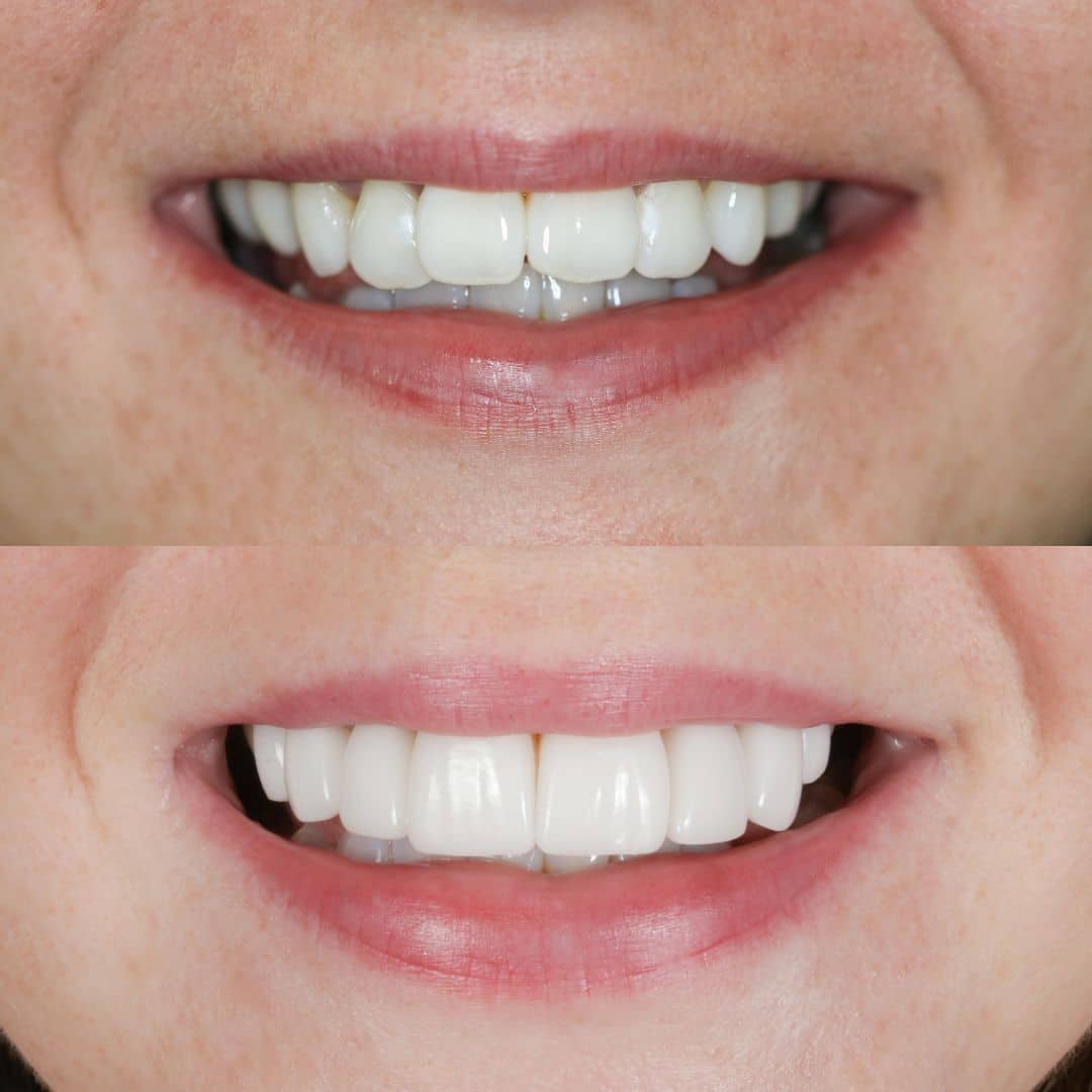 Smile Makeover, porcelain veneers, before and after photo.