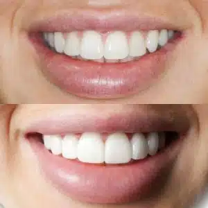 Smile Makeover, porcelain veneers, before and after photo.