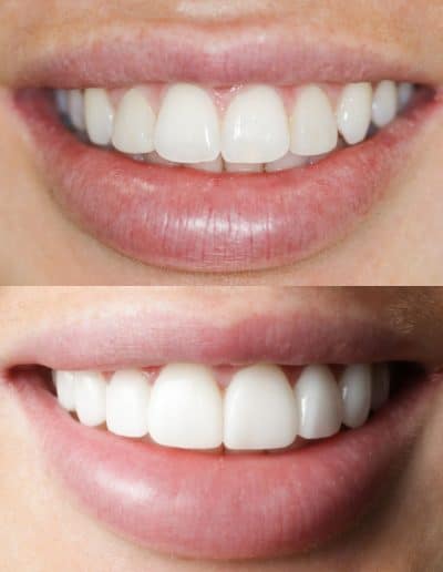 Smile Makeover, porcelain veneers, before and after photo.
