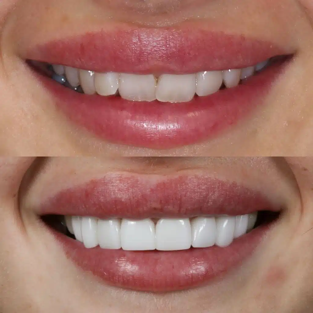 Smile Makeover, porcelain veneers, before and after photo.