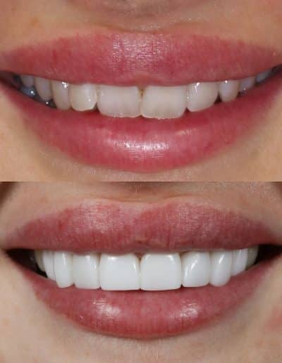 Smile Makeover, porcelain veneers, before and after photo.